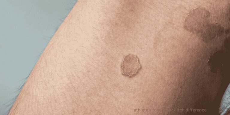 athlete's foot vs jock itch difference