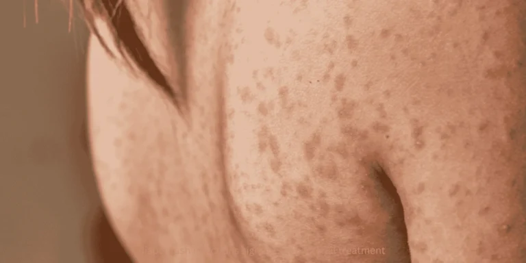 diaper rash infections signs yeast bacterial treatment