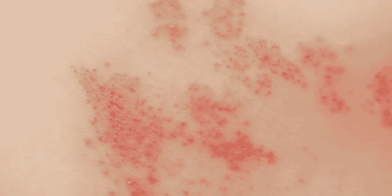 Shingles Rash
